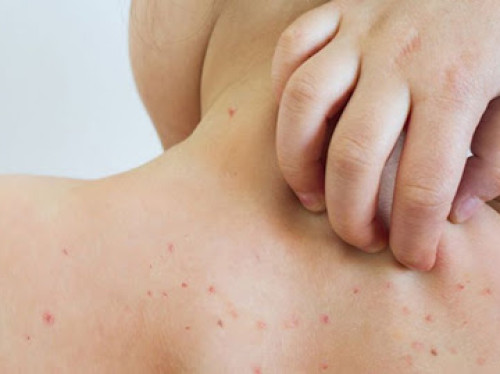 Reportan 50 casos de sarampión en El Salto