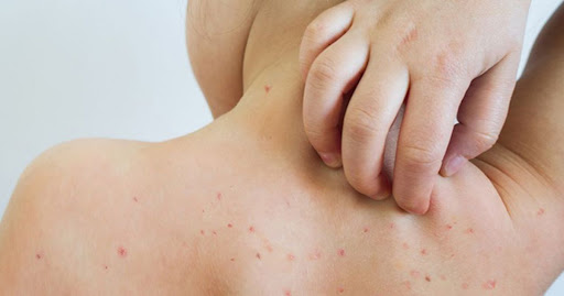 Reportan 50 casos de sarampión en El Salto